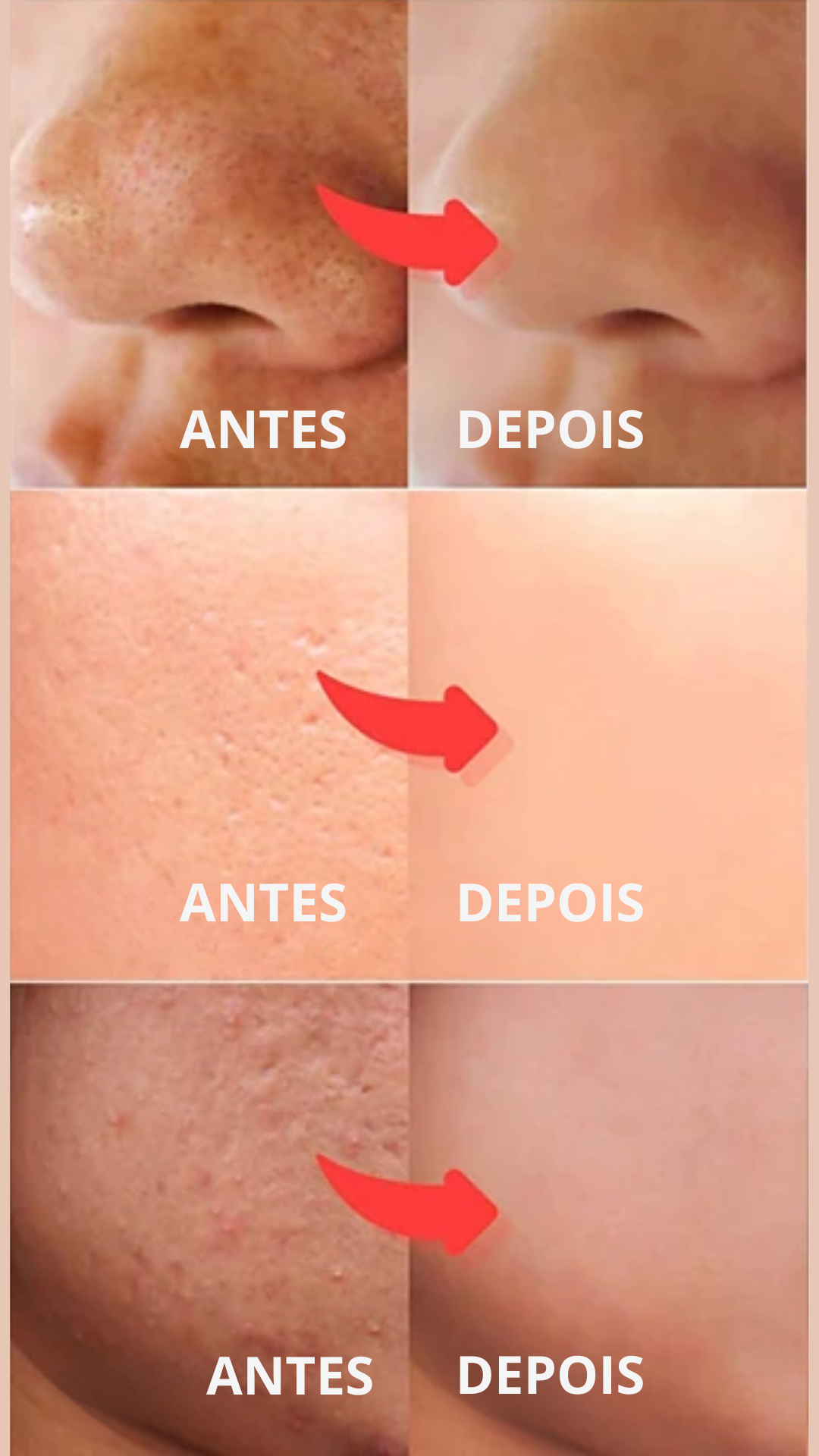 Esfoliador Ultrassônico de Pele: Removedor de Cravos e Limpador Facial com Cavitação