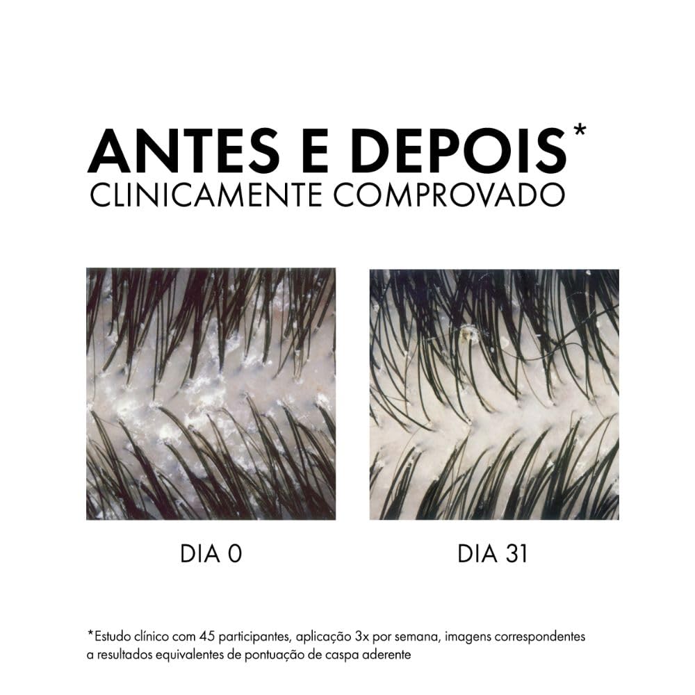 Vichy Dercos DS Shampoo Anticaspa, Tratamento para Cabelos Secos, Elimina 100% da Caspa Visível, Alivia a Coceira e Previne o Reaparecimento por 6 Semanas, 300g